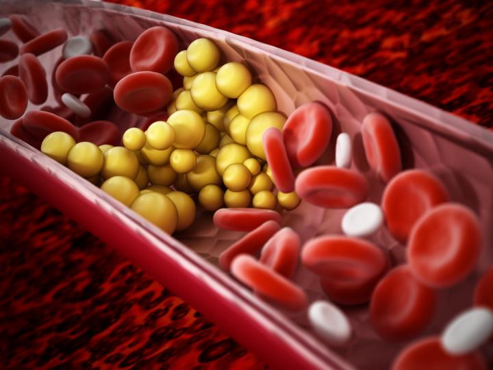 Bempedoic acid, a new treatment for hypercholesterolemia